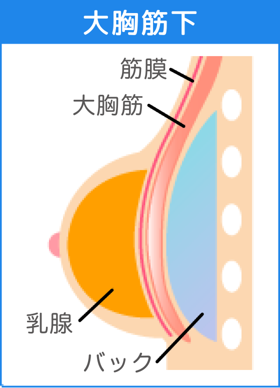 大胸筋下