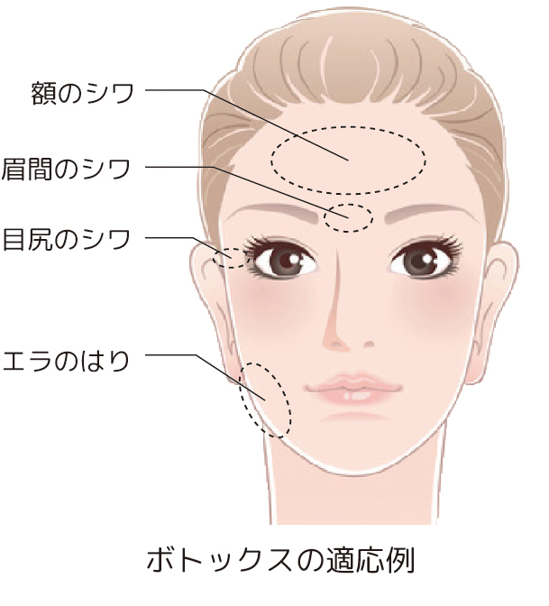 ボトックスの適応例：額のシワ、眉間のシワ、目尻のシワ、エラのはり