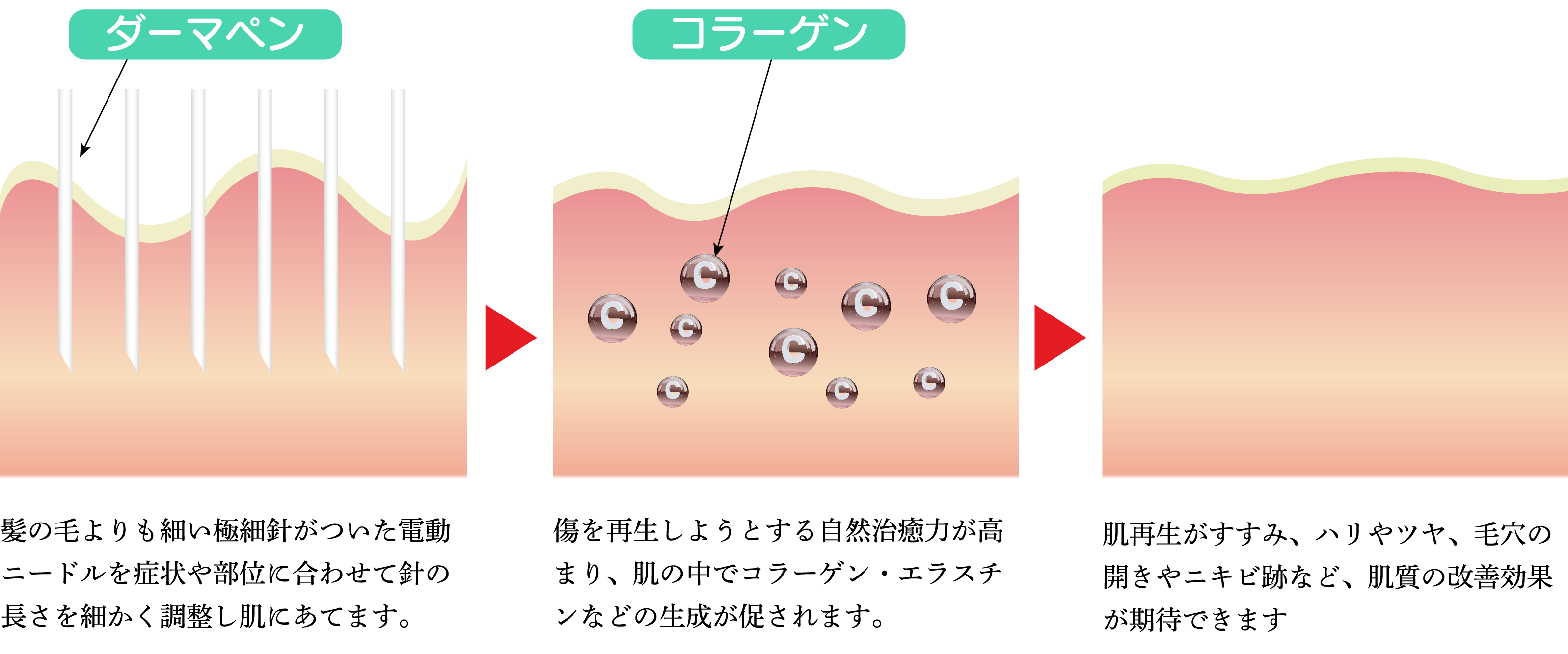 髪の毛よりも細い極細針がついた電動ニードルを症状や部位に合わせて針の長さを細かく調整し肌にあてます。傷を再生しようとする自然治癒力が高まり、肌の中でコラーゲン・エラスチンなどの生成が促されます。肌再生がすすみ、ハリやツヤ、毛穴の開きやニキビ跡など、肌質の改善効果が期待できます