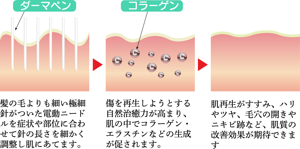 髪の毛よりも細い極細針がついた電動ニードルを症状や部位に合わせて針の長さを細かく調整し肌にあてます。傷を再生しようとする自然治癒力が高まり、肌の中でコラーゲン・エラスチンなどの生成が促されます。肌再生がすすみ、ハリやツヤ、毛穴の開きやニキビ跡など、肌質の改善効果が期待できます