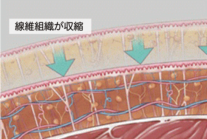 高い脂肪除去率