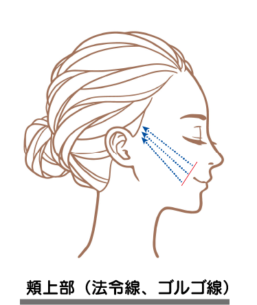頬上部（法令線、ゴルゴ線）