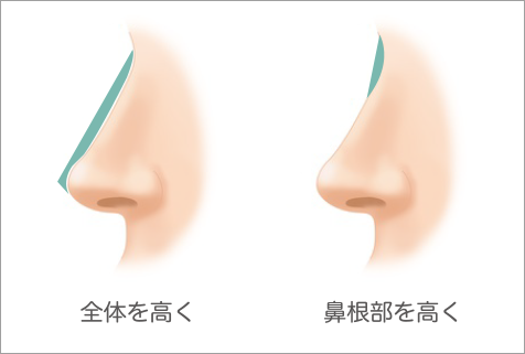 隆鼻術（鼻・鼻筋を高く）