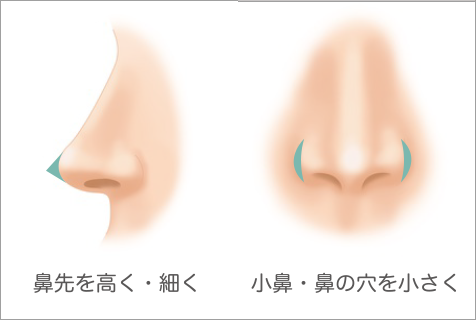 鼻尖形成（鼻先形成）・小鼻縮小