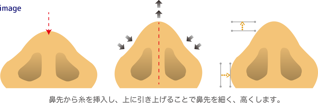 切らない鼻尖形成