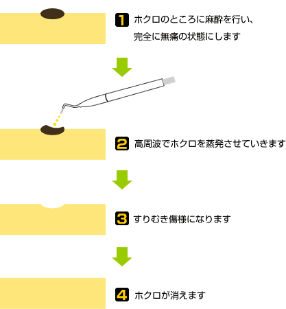 ほくろ・イボ取り