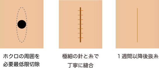 切除